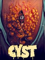 Cyst